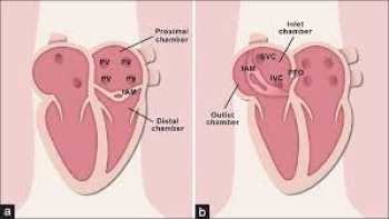 Cor triatriatum’lu ameliyat ettiğim 15 hastaya ait klinik deneyimimiz Eurepean Journal of Cardiothoracic Surgery dergisinde yayınlandı.