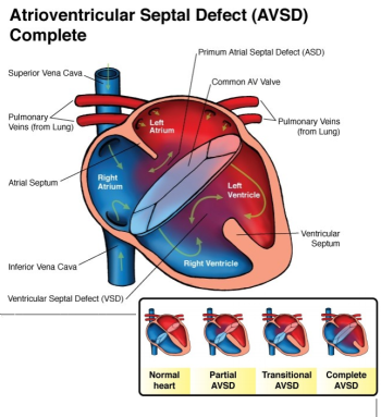 Komplet atrioventriküler kanal defekti